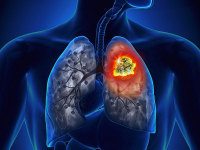 Hướng dẫn cách tập thở khí công và điều chỉnh ăn uống để chữa ung thư ruột di căn sang phổi