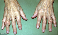 Bệnh gout nổi cục ở bàn tay